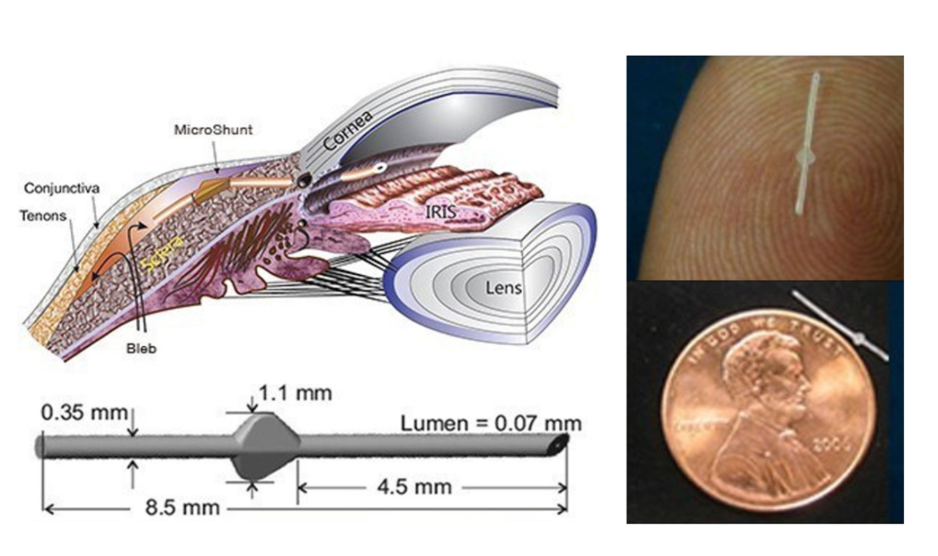 Microshunt device